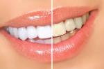 Набор для отбеливания зубов "Luma Smile"
